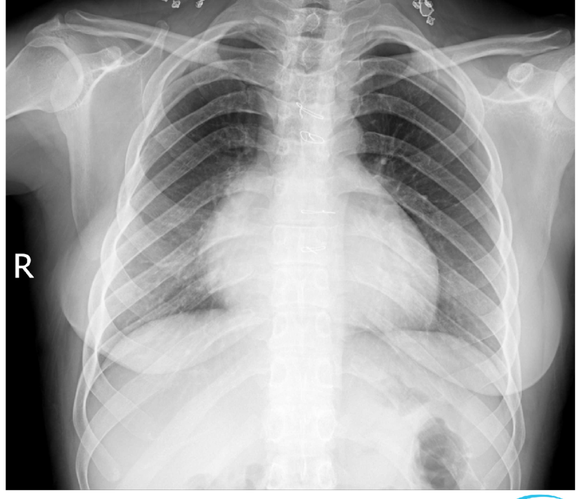 Chest X-Ray of a patient with pulmonary endometriosis showing lung abnormalities.