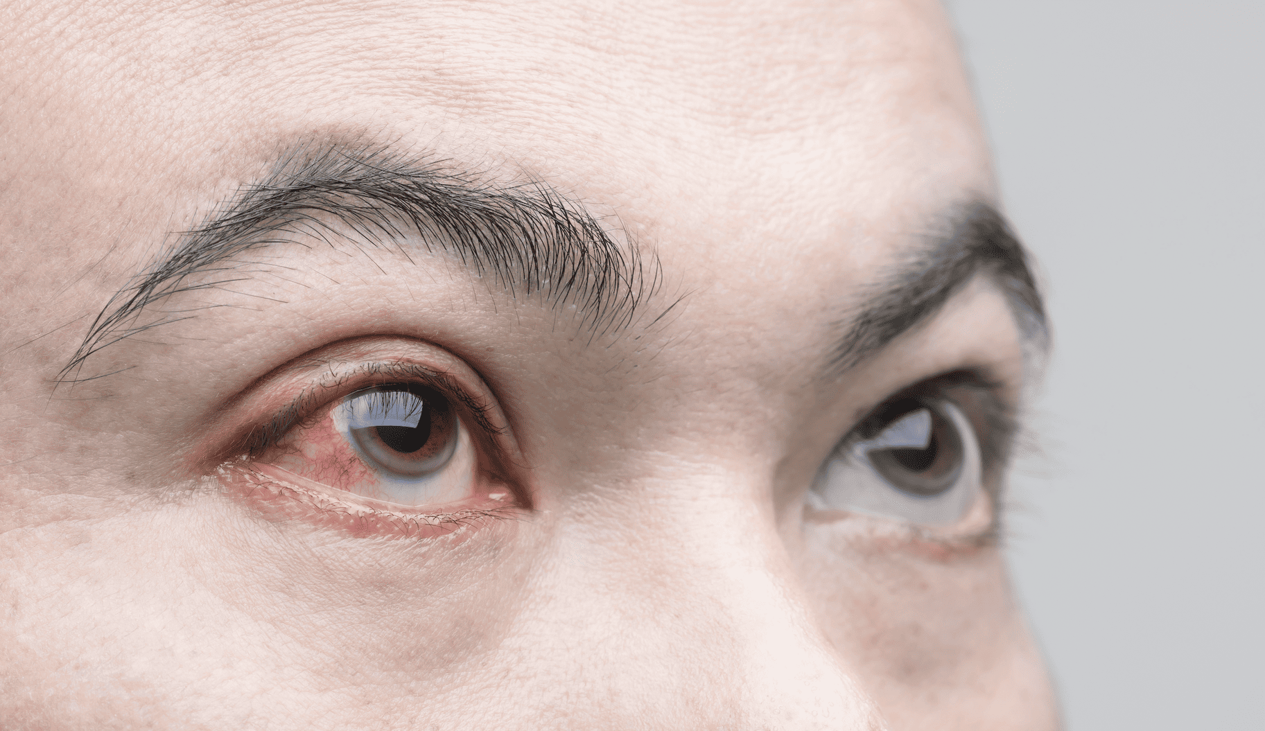 Understanding Corneal Abrasion: Causes, Symptoms, and Treatment