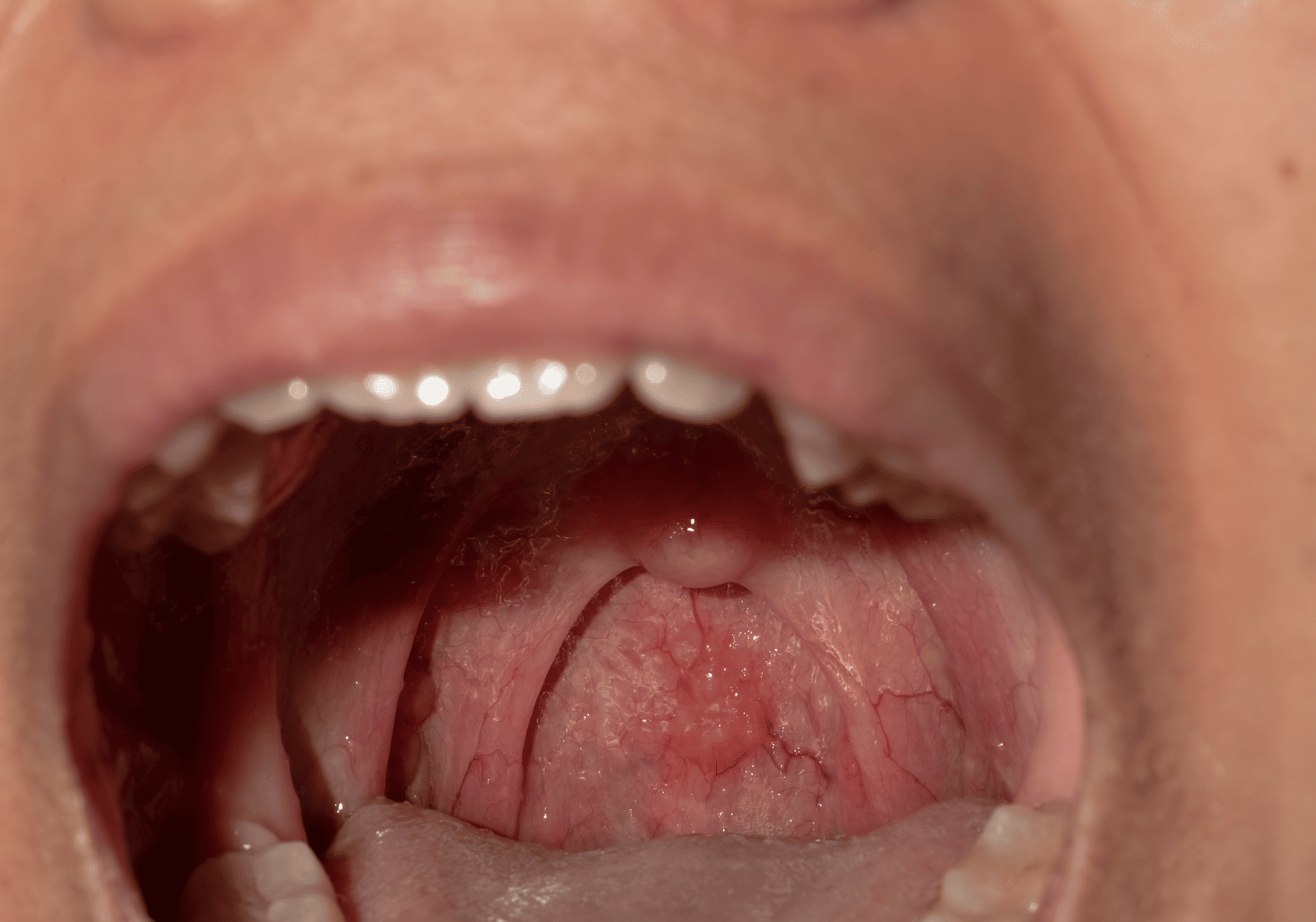 Understanding Peritonsillar Abscess: Causes, Symptoms, and Treatment