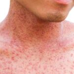 Measles symptoms and prevention – red rash on skin