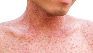 Measles symptoms and prevention – red rash on skin